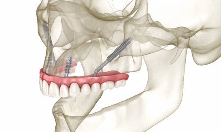 Zygomatic Dental Implants