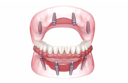 All On 4 Implant Sistem