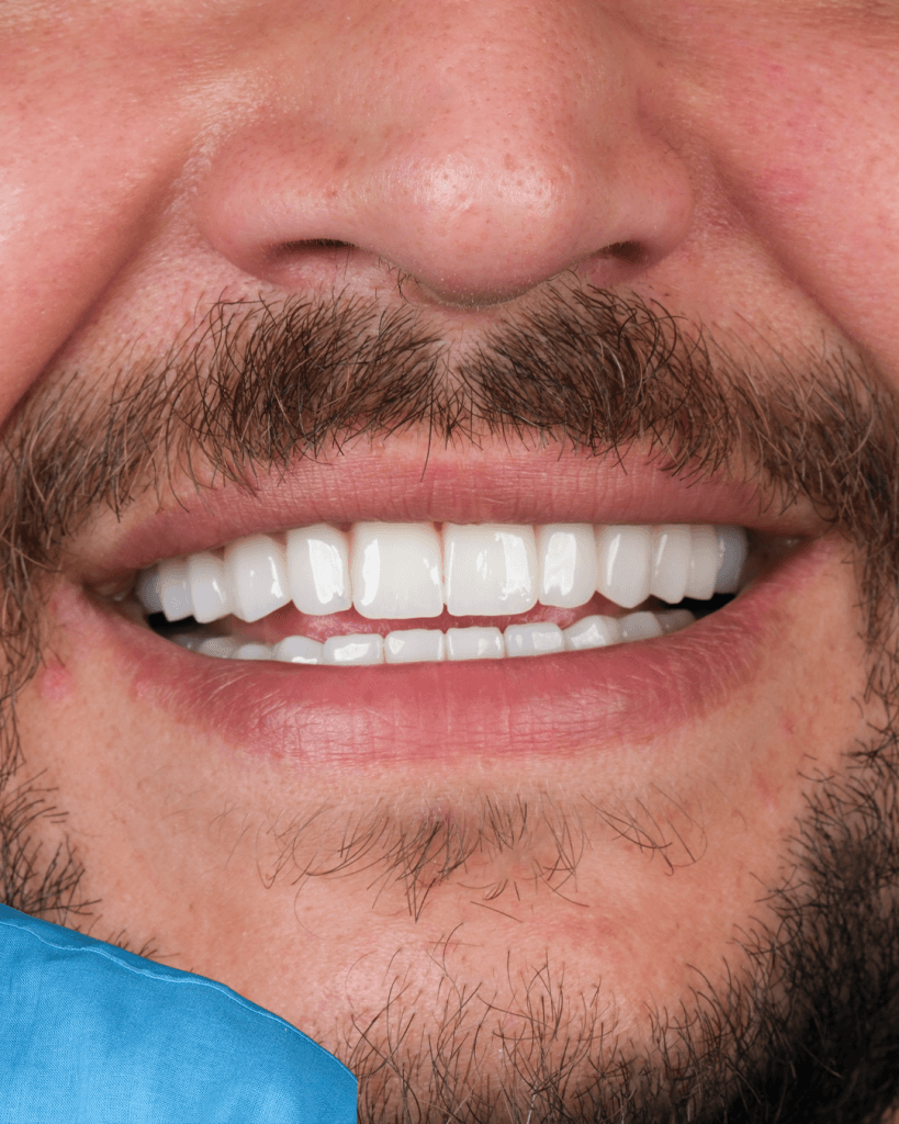 17-Mayis-BA-3-1 - Dr Smile Antalya