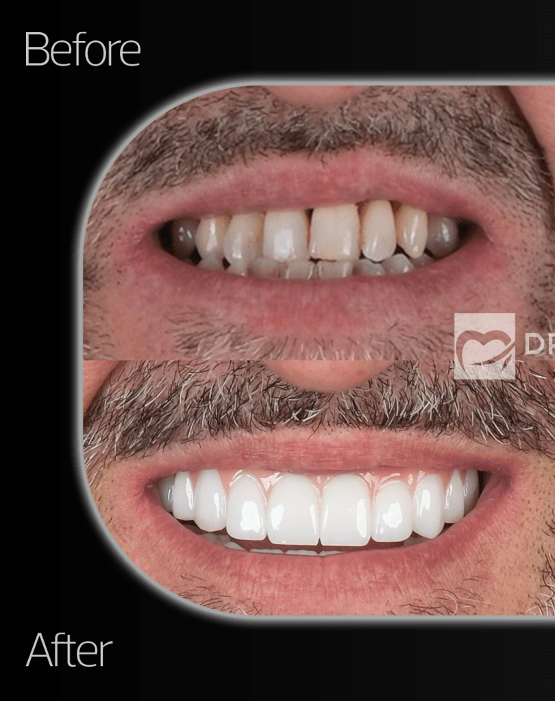 19-May-BA-1 - Dr Smile Antalya