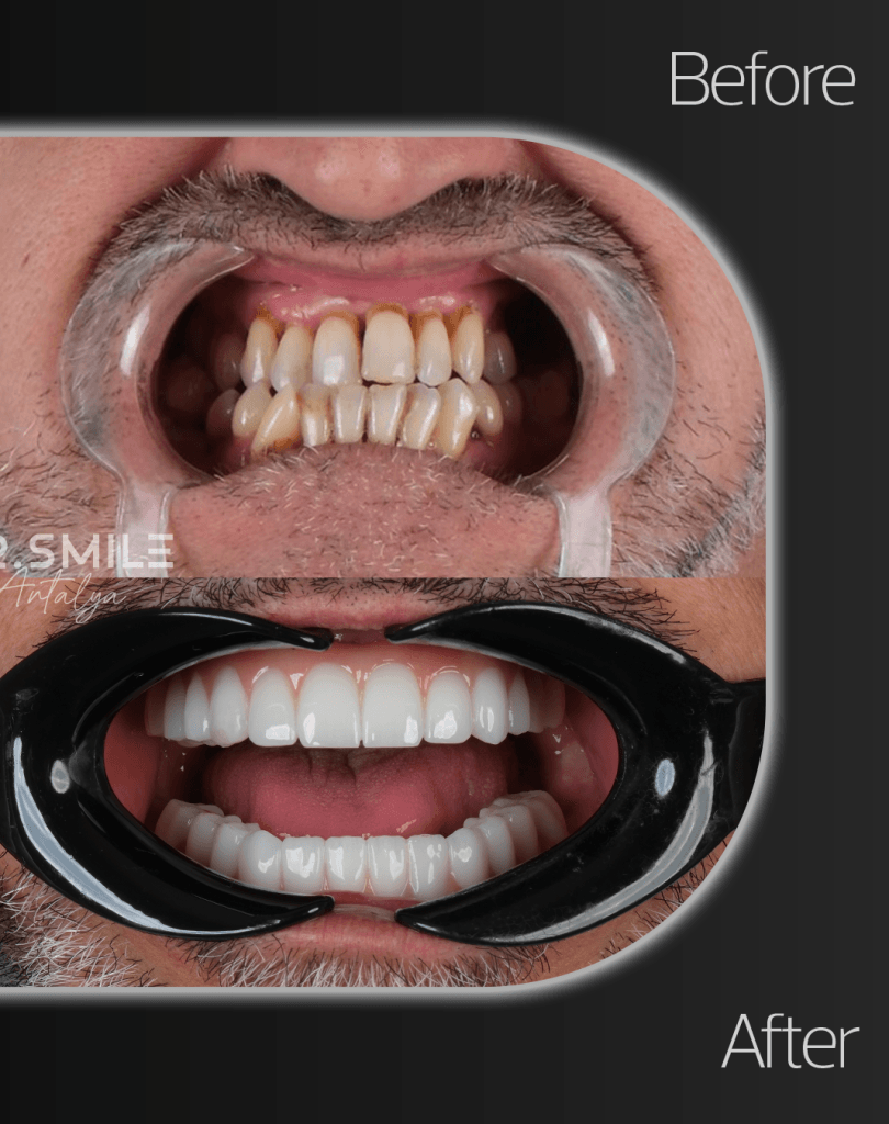 19-May-BA-2 - Dr Smile Antalya
