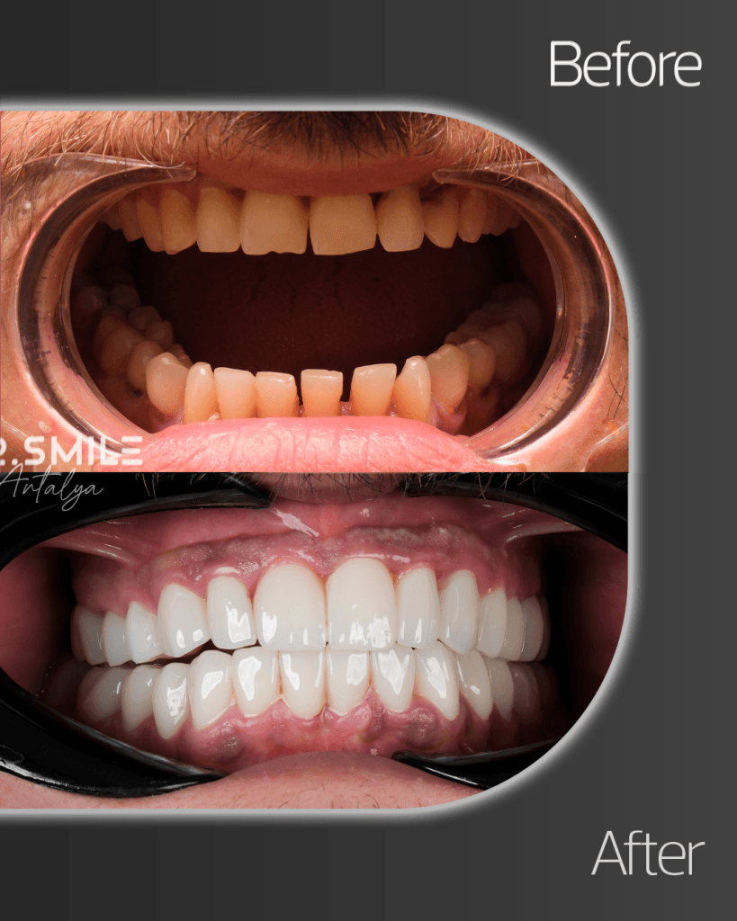 22-Mayis-2 - Dr Smile Antalya