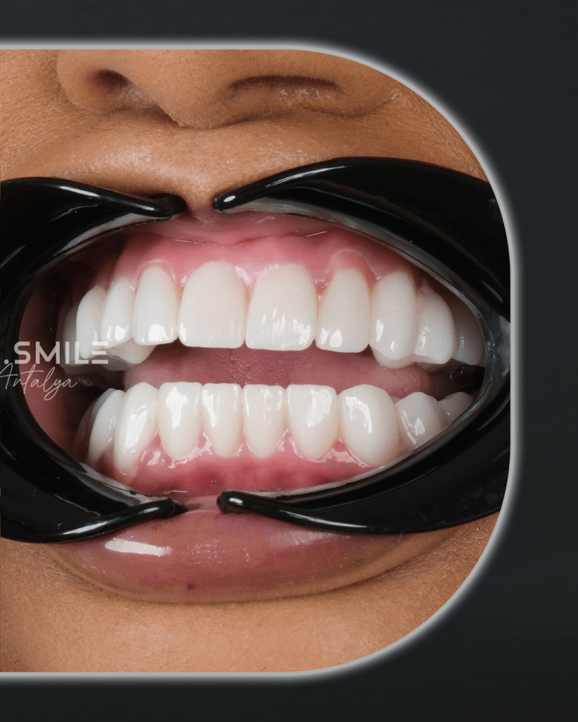 27-Mayis-BA-1_0000_Katman-5 - Dr Smile Antalya