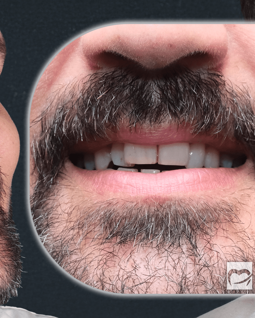 30-Nisan-Before-AfterCalisma-yuzeyi-4