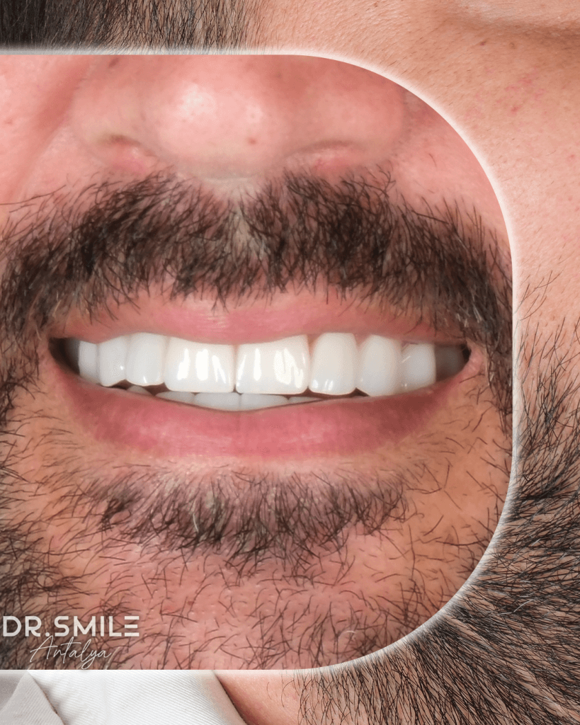 30-Nisan-Before-AfterCalisma-yuzeyi-5