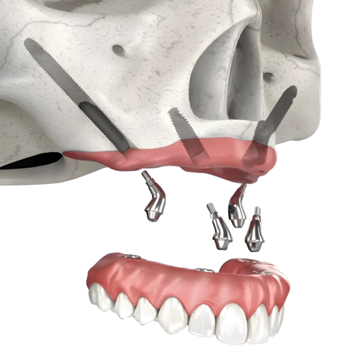 Zygomatic-Implants2-700x700 - Dr Smile Antalya