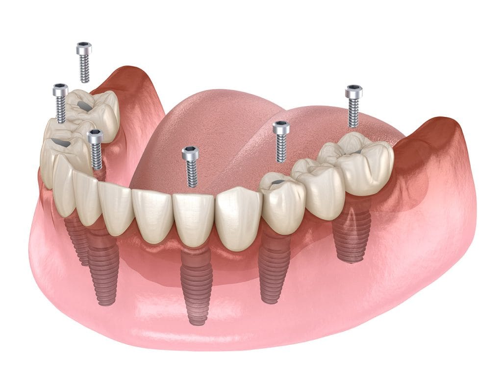 Mandibular,Prosthesis,All,On,4,System,Supported,By,Implants,,Screw - Dr Smile Antalya