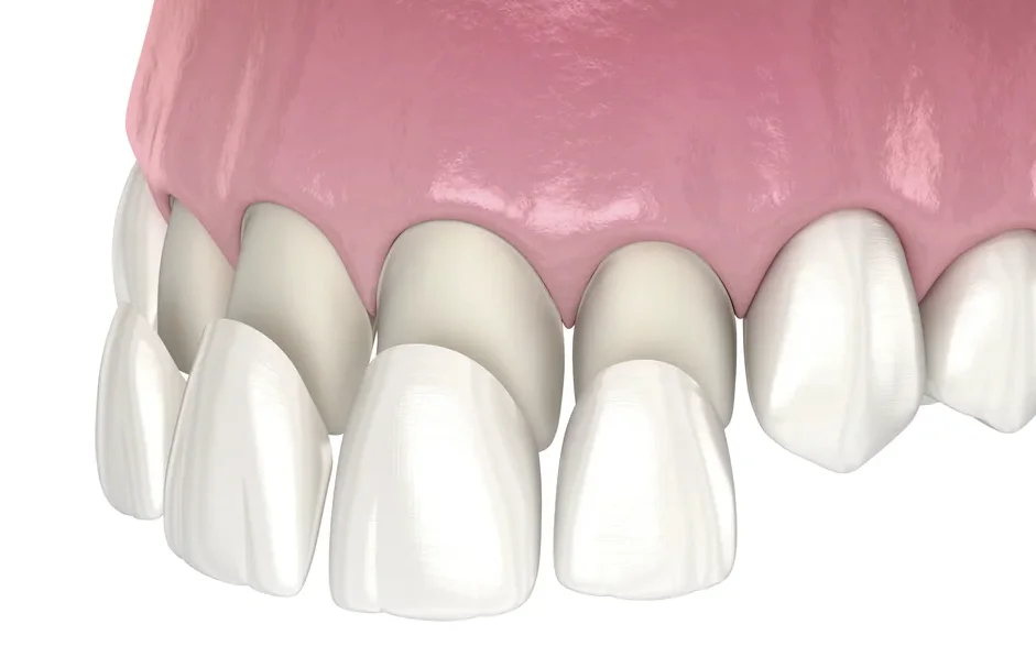 laminate-veneers-diamond-dental-11 - Dr Smile Antalya